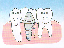 インプラント - 歯が中間で1本抜けた場合