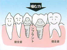 インプラント - 歯が中間で2本抜けた場合