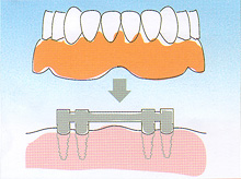 インプラント - 歯が全部抜けた場合