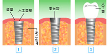 インプラントの治療手順