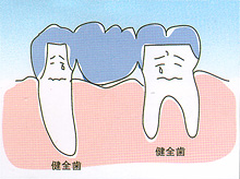 ブリッジ - 歯が中間で1本抜けた場合