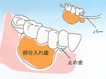 入れ歯 - 部分入れ歯