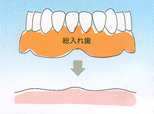 入れ歯 - 総入れ歯