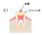 予防歯科/虫歯Ｃ１