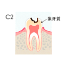 予防歯科/虫歯Ｃ２