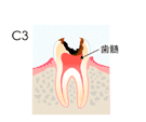 予防歯科/虫歯Ｃ３
