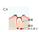 予防歯科/虫歯Ｃ４