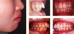矯正歯科症例 治療前