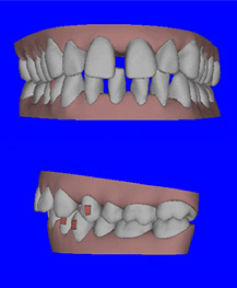 invisalign（インビザライン）