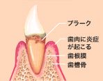 歯肉炎