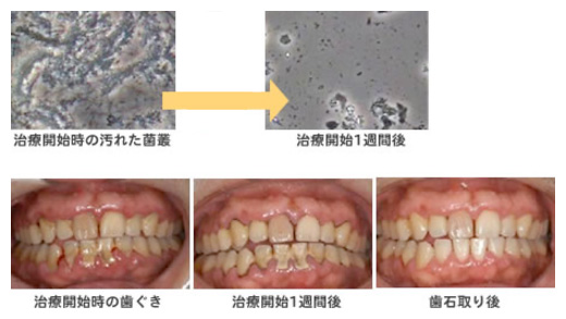 歯周内科治療