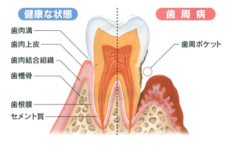 健康な状態と歯周病