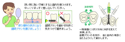 予防歯科/歯磨き法 歯間ブラシ