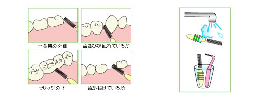 予防歯科/歯磨き法 歯間ブラシ