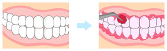 予防歯科/プラーク(歯垢）染め出し前・染め出し後