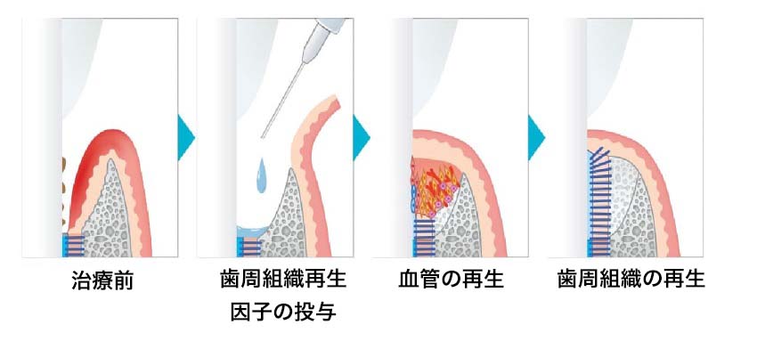 歯周組織再生治療法 | 水天宮・人形町の歯医者｜水天宮前歯科