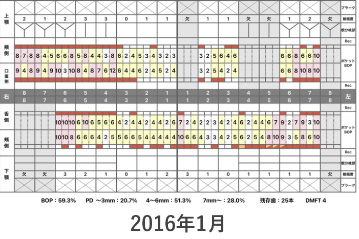 インプラント症例