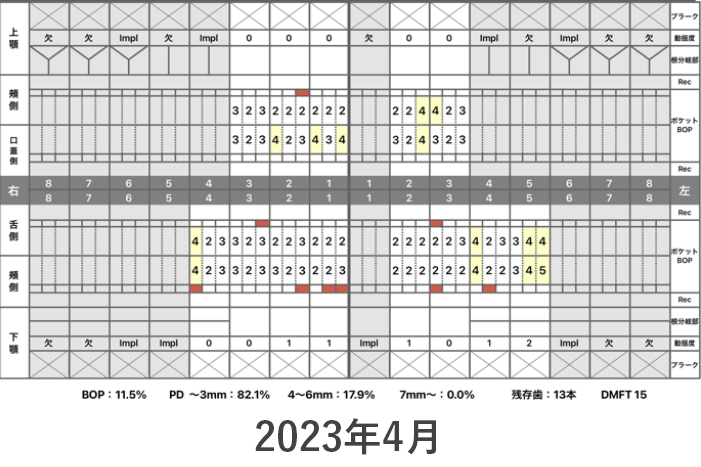 インプラント症例